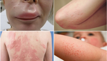 DỊ ỨNG LÀ GÌ? DẤU HIỆU, NGUYÊN NHÂN & CÁCH XỬ LÝ HIỆU QUẢ