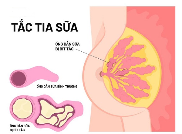 Tắc tia sữa sau sinh là gì?