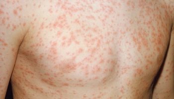 TOÀN THÂN NỔI MẨN ĐỎ CÓ NGUY HIỂM KHÔNG ?