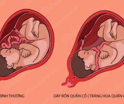 thai-nhi-bi-day-ron-quan-co-co-nguy-hiem-khong