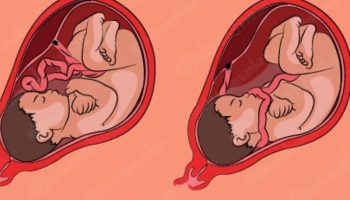 THAI NHI BỊ DÂY RỐN QUẤN CỔ CÓ NGUY HIỂM KHÔNG?