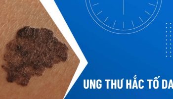 DẤU HIỆU SỚM CỦA UNG THƯ HẮC TỐ DA LÀ GÌ?