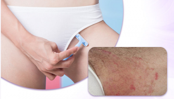CẠO LÔNG VÙNG KÍN CÓ ẢNH HƯỞNG GÌ KHÔNG? BÁC SĨ TRẢ LỜI