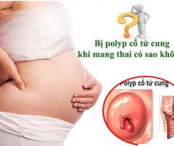 mang-thai-bi-polyp-co-tu-cung-co-sao-khong