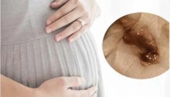Thai 13 tuần ra dịch nâu có nguy hiểm không? Nguyên nhân