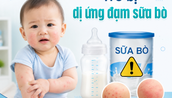 TRẺ BỊ DỊ ỨNG ĐẠM SỮA BÒ: TỔNG HỢP KIẾN THỨC TỪ A – Z