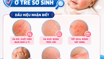 Chàm da ở trẻ sơ sinh là bệnh gì? Có nguy hiểm không?