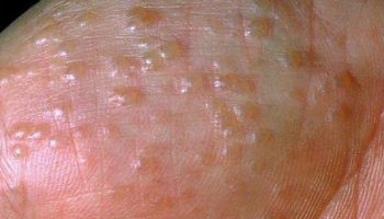Chàm rỉ nước: Nguyên nhân, mức độ nguy hiểm & cách xử lý