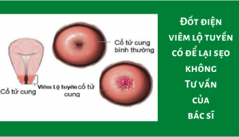 Đốt viêm lộ tuyến có để lại sẹo không? Bác sĩ trả lời nhanh