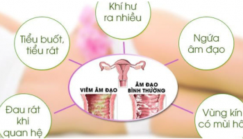 Quan hệ lần đầu có bị viêm âm đạo không? [Hỏi- Đáp bác sĩ]