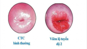 Viêm lộ tuyến có gây ung thư không? Câu trả lời từ bác sĩ chuyên khoa